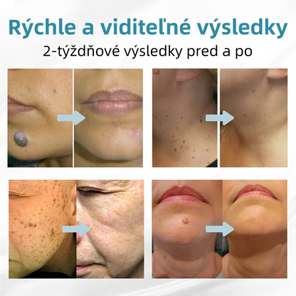 𝐤𝑖𝒅𝘴𝘯𝘦𝘦𝘥® Neinvazívne laserové pero – dôrazne odporúčané Slovenskou dermatovenerologickou spoločnosťou (SDVS) 🔥