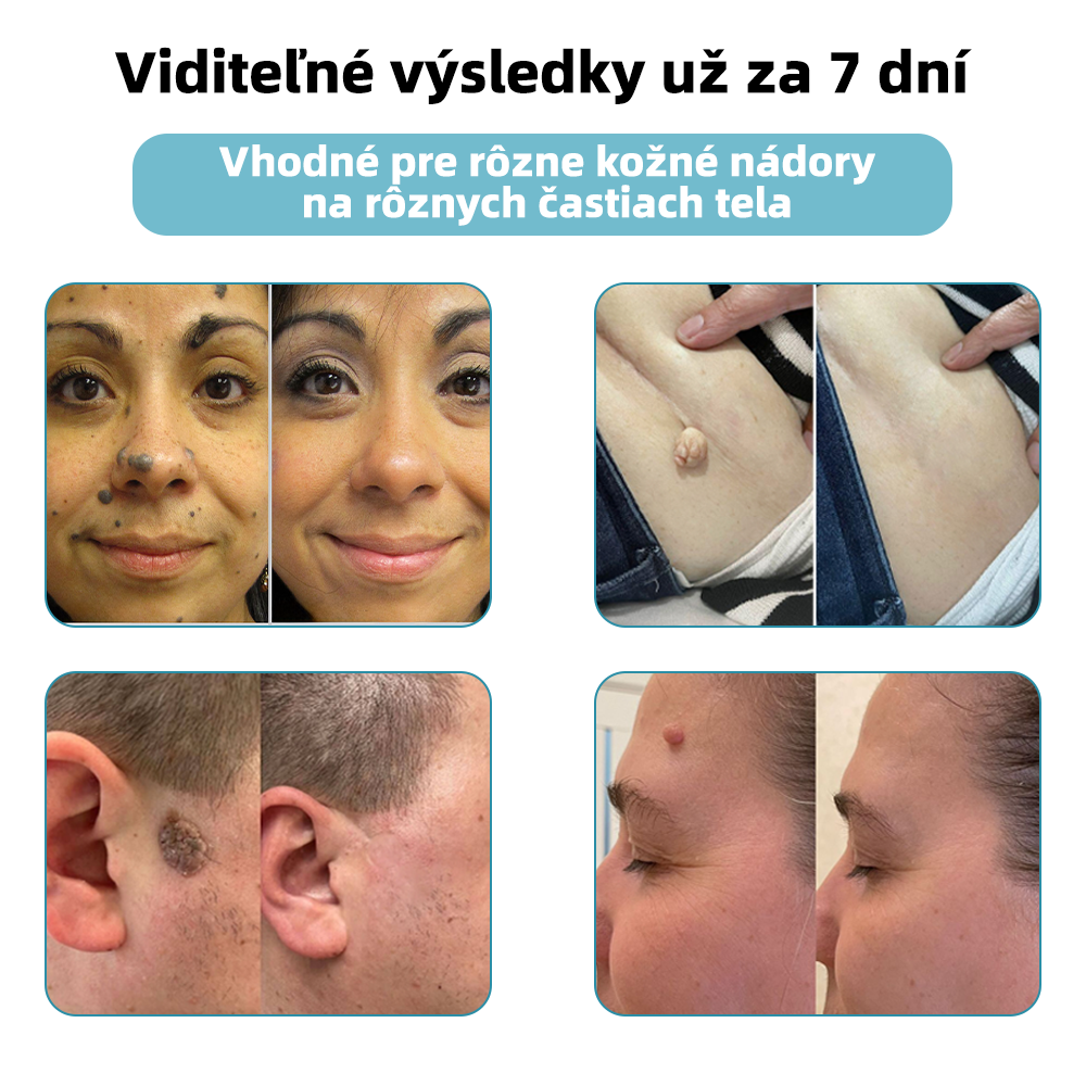 𝐤𝑖𝒅𝘴𝘯𝘦𝘦𝘥® Neinvazívne laserové pero – dôrazne odporúčané Slovenskou dermatovenerologickou spoločnosťou (SDVS) 🔥