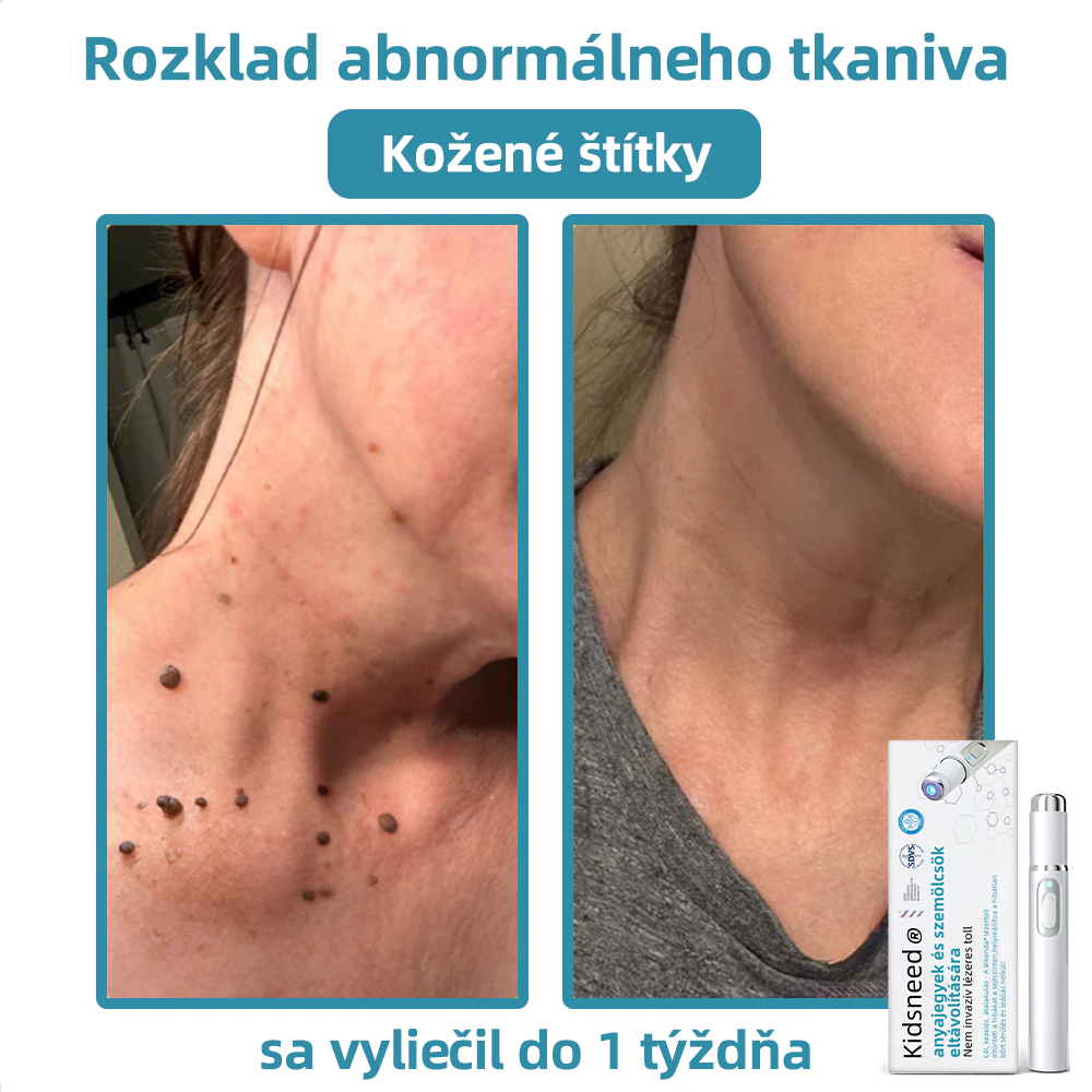 𝐤𝑖𝒅𝘴𝘯𝘦𝘦𝘥® Neinvazívne laserové pero – dôrazne odporúčané Slovenskou dermatovenerologickou spoločnosťou (SDVS) 🔥