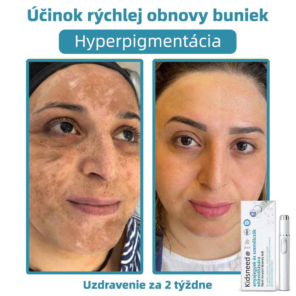 𝐤𝑖𝒅𝘴𝘯𝘦𝘦𝘥® Neinvazívne laserové pero – dôrazne odporúčané Slovenskou dermatovenerologickou spoločnosťou (SDVS) 🔥