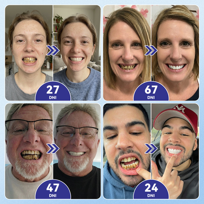 𝑮𝒍𝒊𝒎𝒎𝒆𝒓𝒍𝒚®🦷 𝑻𝒊𝒅𝒆𝒈𝒍𝒖𝒔𝒊𝒃 𝒎𝒊𝒌𝒓𝒐𝒊𝒉𝒍𝒊č𝒌𝒐𝒗é 𝒏á𝒑𝒍𝒂𝒔𝒕𝒊 𝒏𝒂 𝒐𝒃𝒏𝒐𝒗𝒖 𝒛𝒖𝒃𝒐𝒗 𝒂 ď𝒂𝒔𝒊𝒆𝒏 👩‍⚕️(𝑂𝑏𝑛𝑜𝑣𝑎 𝑧𝑢𝑏𝑛𝑒𝑗 𝑠𝑘𝑙𝑜𝑣𝑖𝑛𝑦 𝑎 𝑑𝑒𝑛𝑡í𝑛𝑢 • 𝑆𝑝𝑒𝑣𝑛𝑒𝑛𝑖𝑒 ď𝑎𝑠𝑖𝑒𝑛 • 𝑂𝑑𝑠𝑡𝑟𝑎ň𝑜𝑣𝑎𝑛𝑖𝑒 𝑧𝑢𝑏𝑛éℎ𝑜 𝑝𝑜𝑣𝑙𝑎𝑘𝑢 𝑎 𝑧á𝑝𝑎𝑐ℎ𝑢 • 𝑍𝑚𝑖𝑒𝑟𝑛𝑒𝑛𝑖𝑒 𝑐𝑖𝑡𝑙𝑖𝑣𝑜𝑠𝑡𝑖 𝑧𝑢𝑏𝑜𝑣)❤️‍🔥