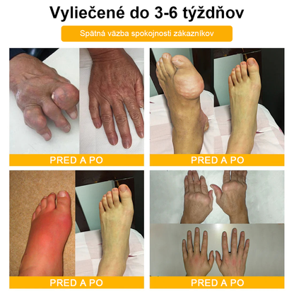 FATONG™ Krém na bolesti kĺbov s včelím jedom na hojenie kostí(🐝špeciálne pre starších dospelých a odporúča AAOS) 🐝