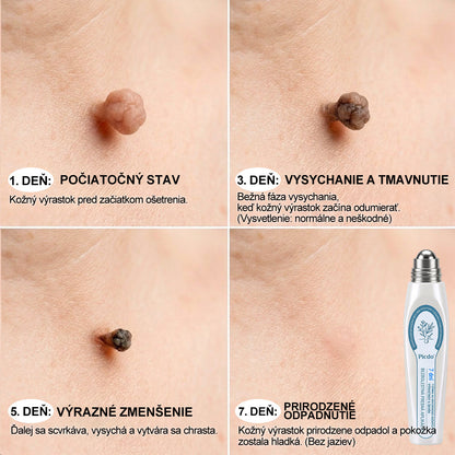 𝐏i𝐜𝐝o® 7-𝐷𝑎𝑦 𝗧𝐚𝐠 & 𝗦𝗽𝐨𝐭 𝐄𝐫𝒂𝒔𝒆𝒓(Zero Pain, Zero 𝐒𝐜𝐚𝒓𝒔 Rollerball)💪