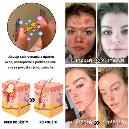 （🔥Posledný deň výpredaja - 80% zľava）𝐶𝑍𝑇𝐼𝐶𝐿𝐸™ 💖Lymfatický magnetický terapeutický prsteň s mačacím okom